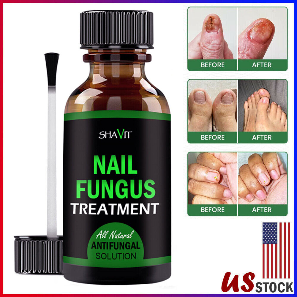 Extra Strength Fungal Treatment for Toenail & Athlete's Foot 9
